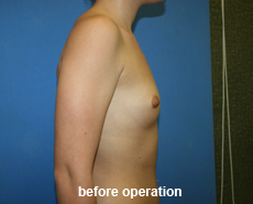 plastic-surgery-breast-augmentation